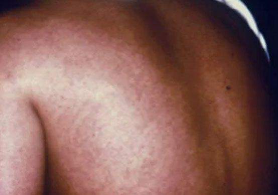 71410 marburg virus outbreak in equatorial guinea ends 71410 marburg virus outbreak in equatorial guinea ends