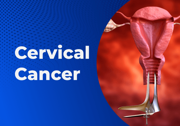 71451 bleeding after intercourse may be sign of cervical cancer expert 71451 bleeding after intercourse may be sign of cervical cancer expert
