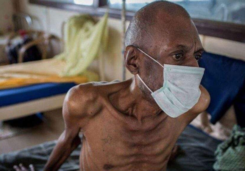 76500 new tb vaccine in 100 years advances as wellcome gates foundation fund trial 76500 new tb vaccine in 100 years advances as wellcome gates foundation fund trial