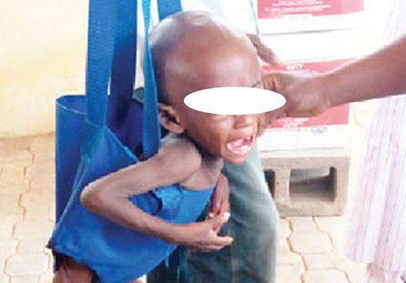 9067 malnutrition may delay childrens recovery from infections dietician