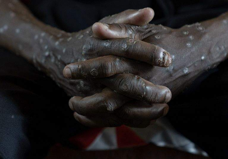 Congolese Authorities Receive 50,000 Smallpox Vaccines Congolese Authorities Receive 50,000 Smallpox Vaccines