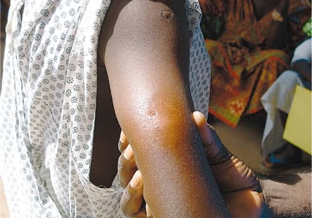 8 persons killed as Adamawa govt  confirms outbreak of suspected Buruli ulcer — Daily Nigerian