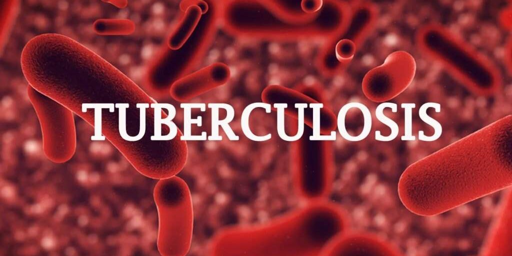 End TB Stigma: Breakthrough Action Needed for Survivors' Wellbeing End TB Stigma: Breakthrough Action Needed for Survivors' Wellbeing