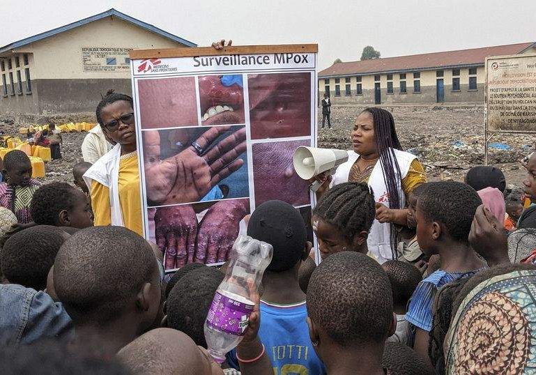 Monkeypox Outbreak Spreads in Congo with Rising Cases and Higher Monkeypox Outbreak Spreads in Congo with Rising Cases and Higher
