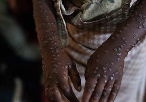 Mpox Case Recorded in Marrakesh, Morocco's First Mpox Case Recorded in Marrakesh, Morocco's First