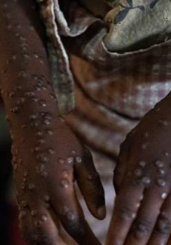 Mpox Case Recorded in Marrakesh, Morocco's First