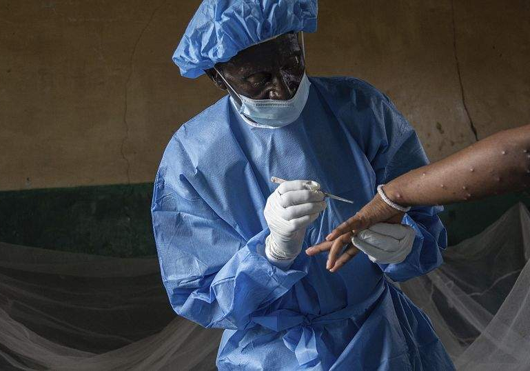 Mpox Outbreak Spreads Fear in Eastern DRC
