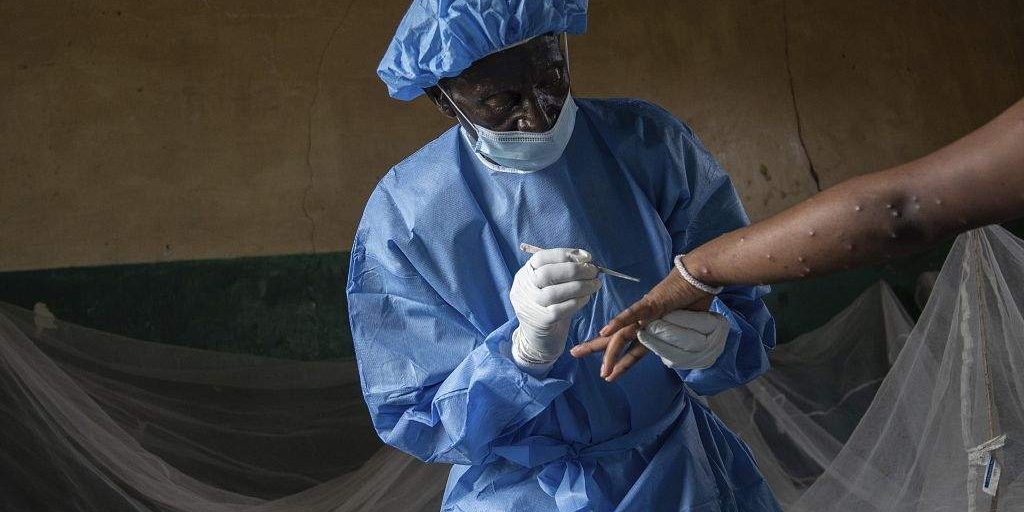 Mpox Outbreak Spreads Fear in Eastern DRC Mpox Outbreak Spreads Fear in Eastern DRC