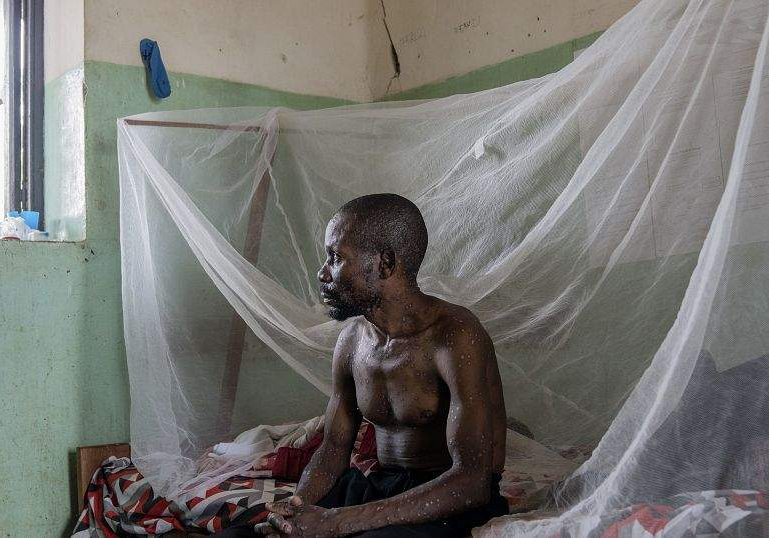 Mpox Outbreak Spreads in DRC, Vaccination Key to Containment Mpox Outbreak Spreads in DRC, Vaccination Key to Containment