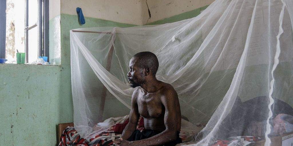 Mpox Outbreak Spreads in DRC, Vaccination Key to Containment Mpox Outbreak Spreads in DRC, Vaccination Key to Containment