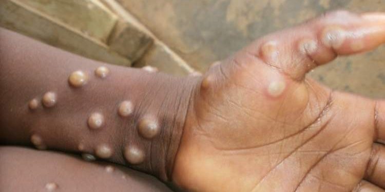 Mpox Outbreak: Two New Cases Confirmed in Cross River State Mpox Outbreak: Two New Cases Confirmed in Cross River State