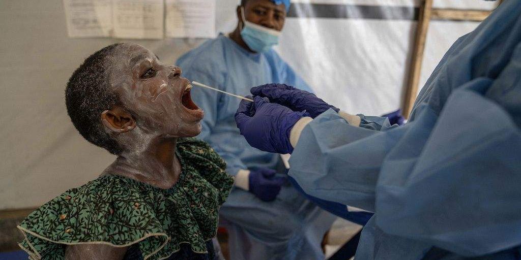 Mpox Outbreak Wreaks Havoc in DR Congo, Patients Struggle with