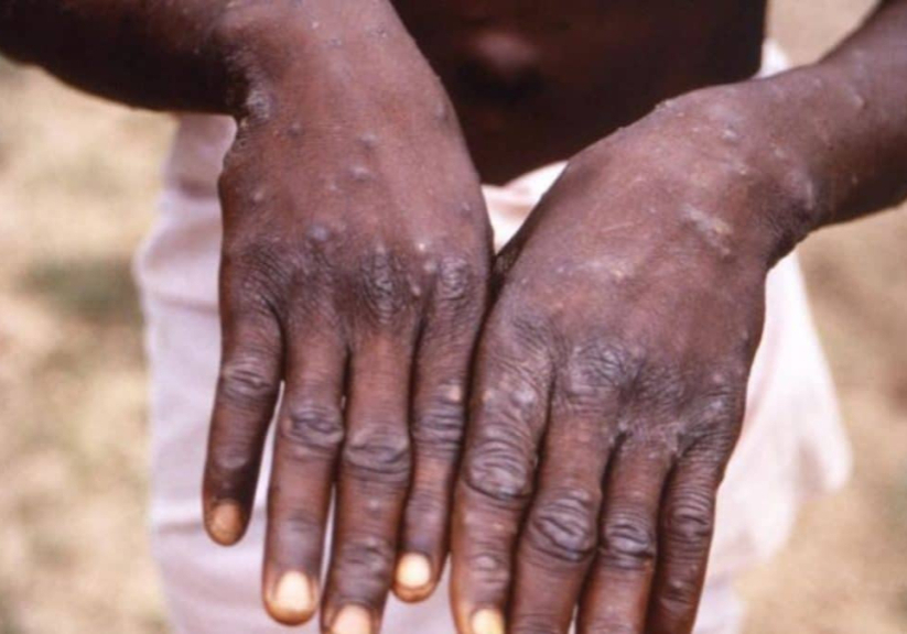 Nigerian govt issues fresh alert on Degue, Cholera, Mpox, Diphtheria outbreaks