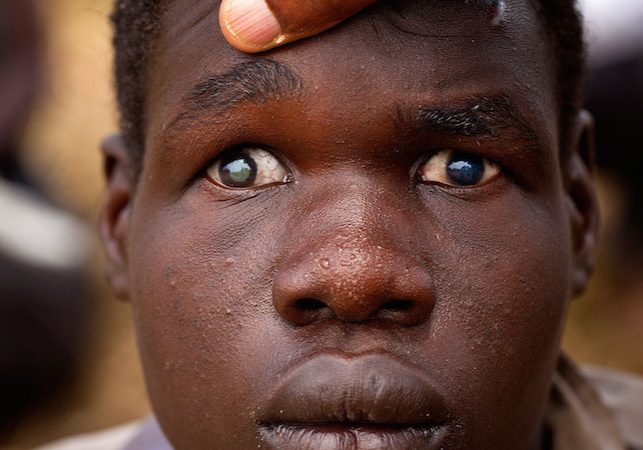 Nigeria Eye Health Crisis Affects 23 Million People 23 million Nigerians suffer from eye problems - Expert