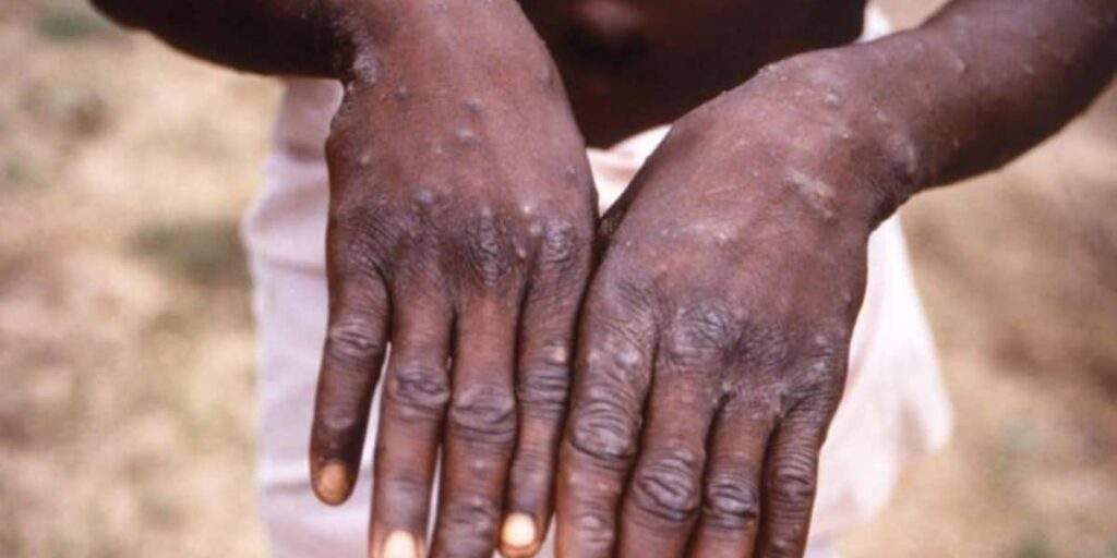 Nigeria Reports Decline in Mpox Cases, 51 New Suspected Cases Nigeria Reports Decline in Mpox Cases, 51 New Suspected Cases