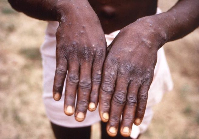 Ondo records 12 cases of Mpox