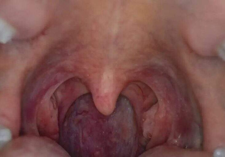 Oral Sex Linked to Rising Throat Cancer Cases
