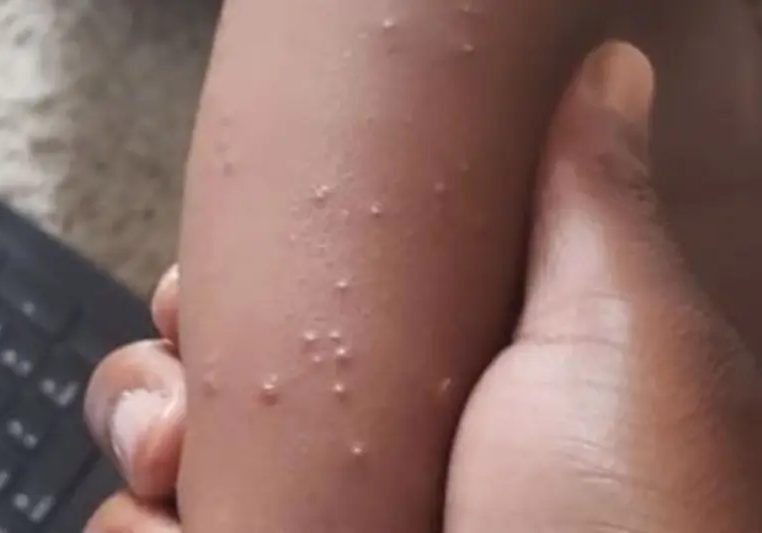 Scabies infects 150 in Adamawa