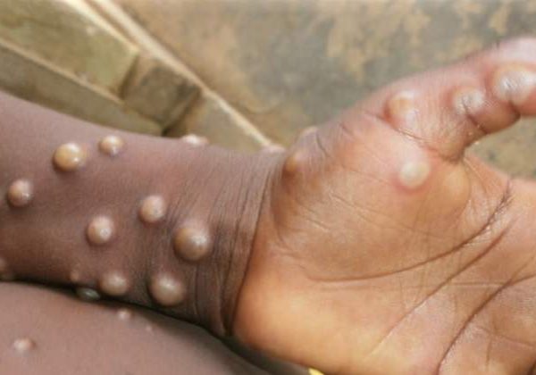 WHO Lists First Mpox Diagnostic Test for Global Access WHO Lists First Mpox Diagnostic Test for Global Access
