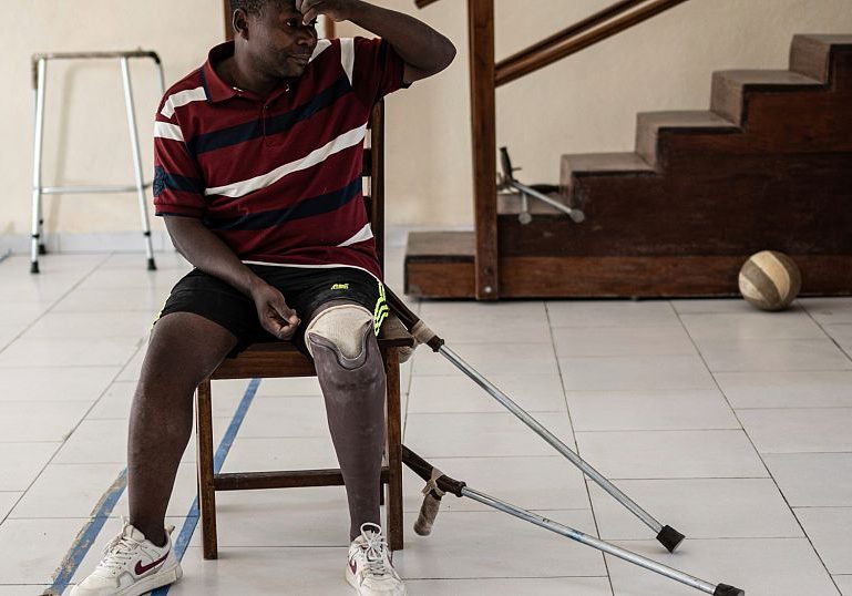 Amid escalating violence in Eastern Congo, demand for prosthetics soars