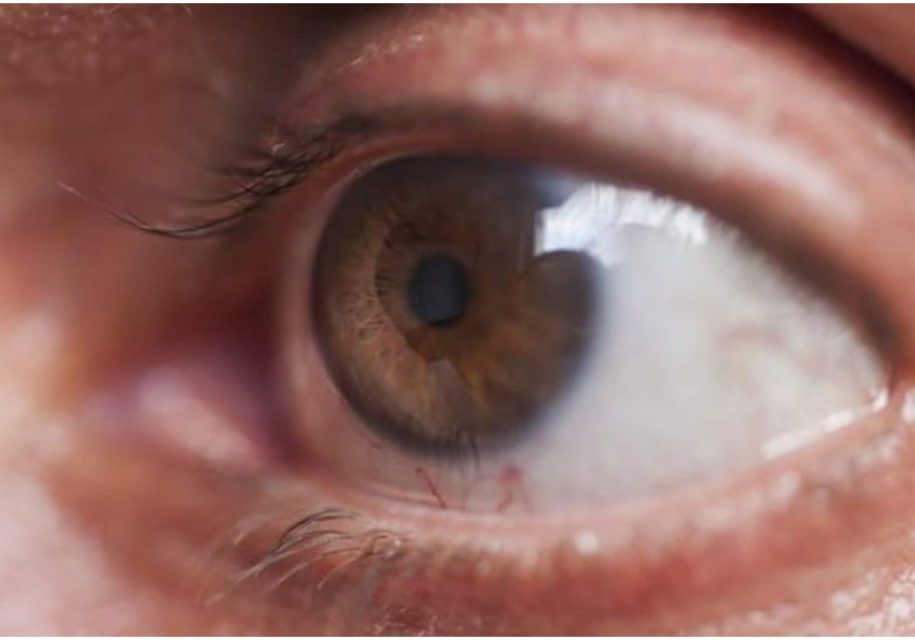 Experts raise concerns as glaucoma cases surge in Plateau